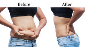 A woman body fat belly between before and after weight loss.